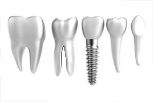 Ventajas o beneficios de los implantes dentales