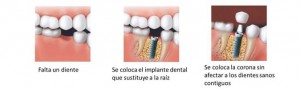 implantes dentales