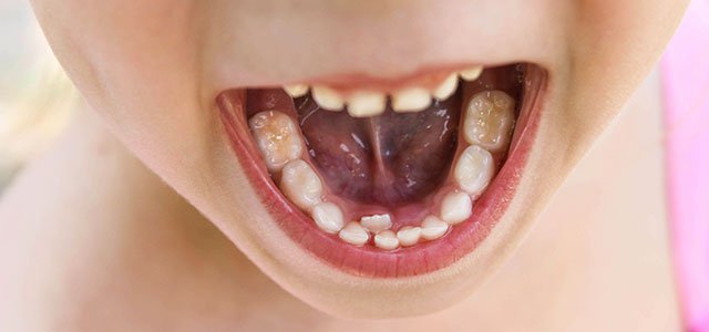 Desaparecer dos Desempacando Que hacemos si a un niño le sale el diente definitivo por detrás del de  leche? | Aixerrota Clínica Dental