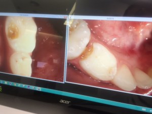 fotografía intraoral de caries en dientes de leche.