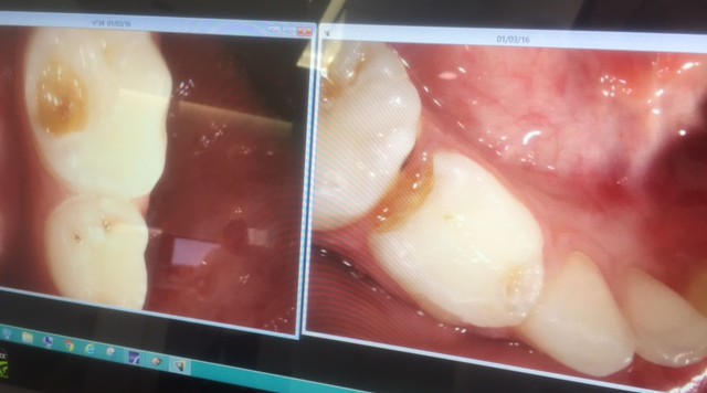 fotografía intraoral de caries en dientes de leche.