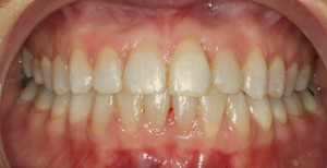 foto oclusal frontal tras tratamiento