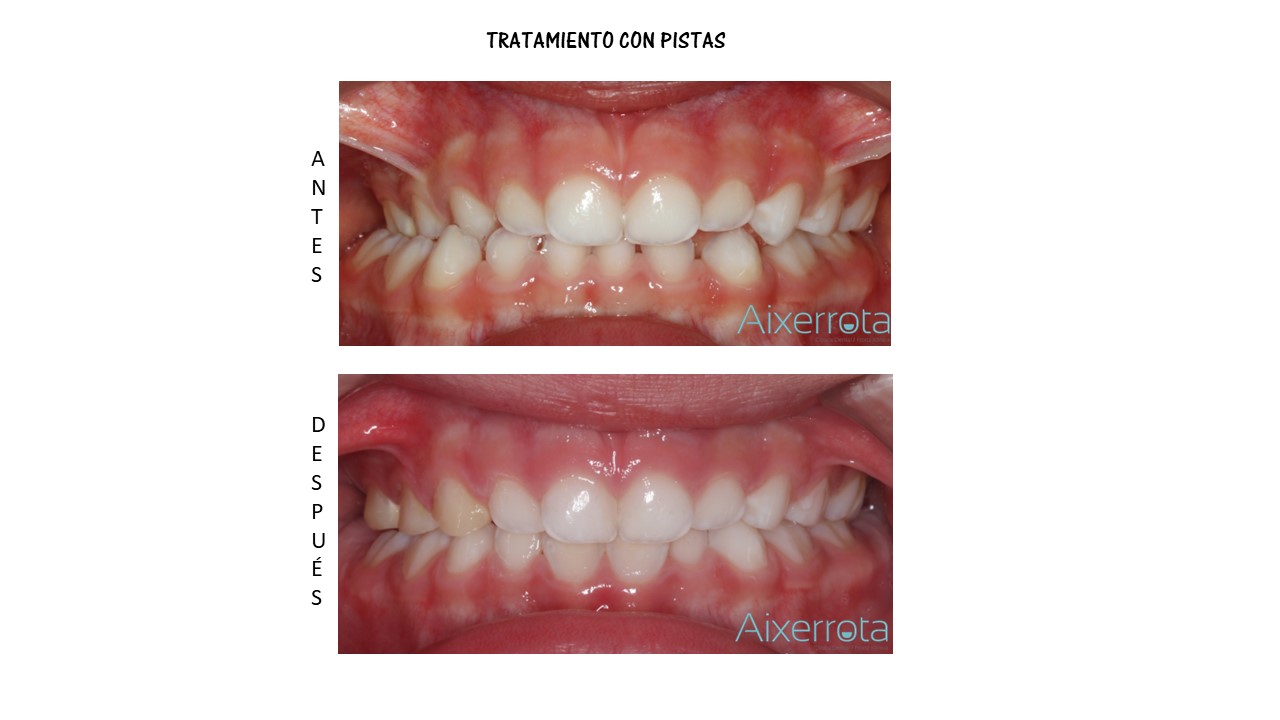 tratamiento RNO con pistas